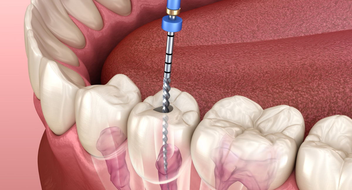 Why Root Canals Are the Best Way to Save Your Teeth from Extraction